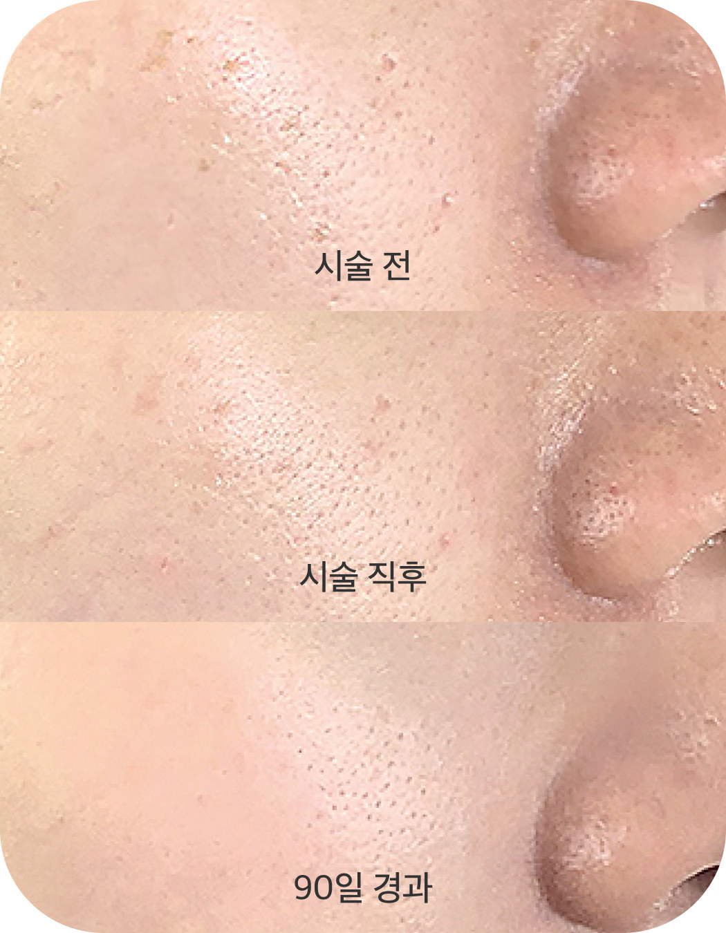 시술 전 / 시술 직후 / 90일 경과 피부 변화